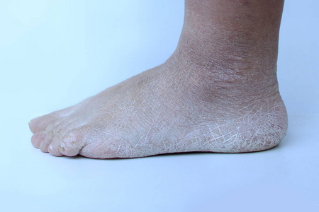 诊所 医学 损害 干燥 真菌 疾病 脱水 皮炎 卫生 脚后跟