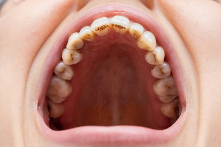 牙医 面对 填满 牙龈炎 脓肿 女人 口香糖 牙科 衰退