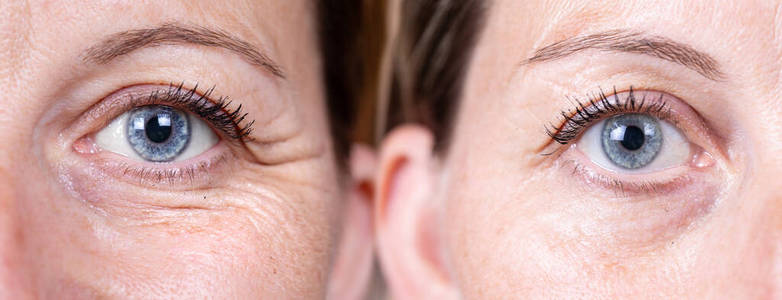 成人 面部 眼睑 塑料 健康 病人 举起 皮肤 比较 美女