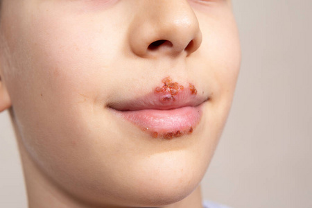感染美丽唇疱疹病毒