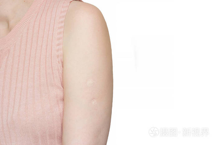 在一名成年妇女的肩膀上可以看到儿童时期制造的结核病疫苗卡介苗痕迹
