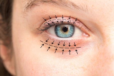 外科手术 皮肤 特写镜头 视力 去除 眼睑成形术 皱纹 老化