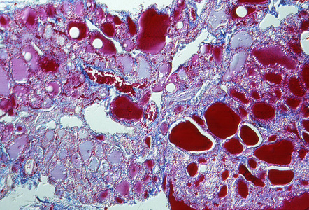 研究 甲状腺肿 胶体 科学 组织学 医学 病理学 疾病 甲状腺