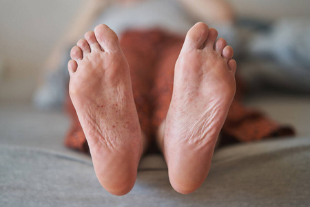 eczema on the feet of a young girl. 