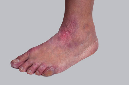 过敏性皮疹治疗膏在l一个患有慢性银屑病的男人的腿特写一个患有慢性