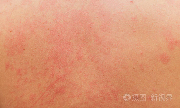 浅表性皮疹像鸡皮疙瘩(皮肤似鸡皮疙瘩似的是怎么回事) 浅表性皮疹像鸡皮疙瘩(皮肤似鸡皮疙瘩似的是怎么回事)