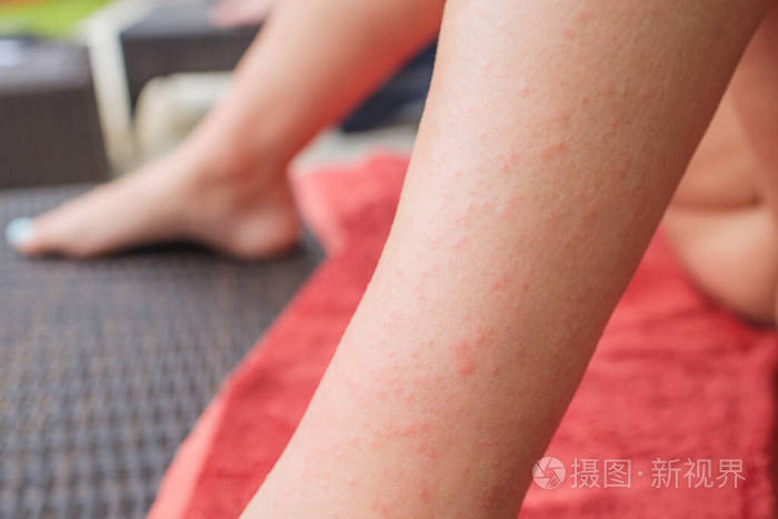 一名非肉质面筋过敏妇女的疱疹样皮炎皮疹血清抗体对小麦和面筋呈阳性