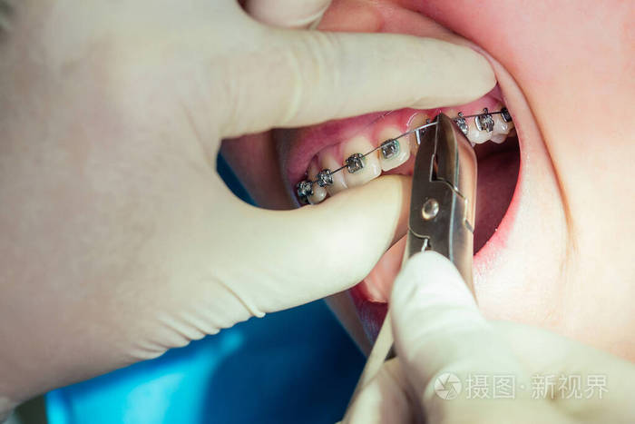 女性牙齿张开嘴固定器凝胶支架接收支架系统卡帕特写