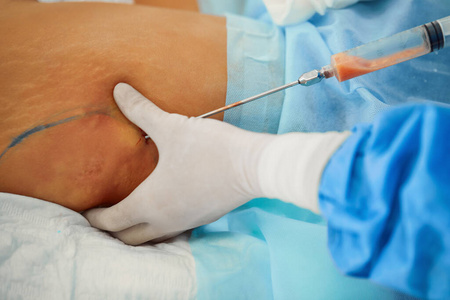 腹部脂肪沉积的吸脂矫正整形手术.美丽和成功,瘦削的身体.照片