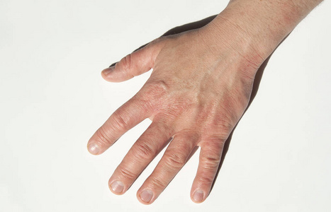 钉子 皮疹 表皮 皮肤科 照顾 混乱 病人 人类 皮炎 疼痛