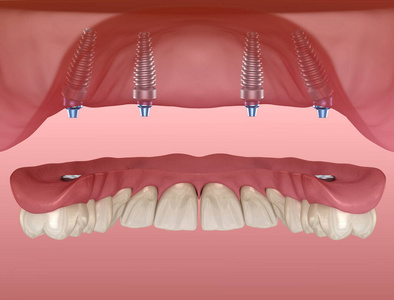 牙齿 透明的 安装 植入式 恢复 疼痛 诊所 插图 保护