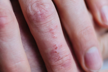 手指结痂图片