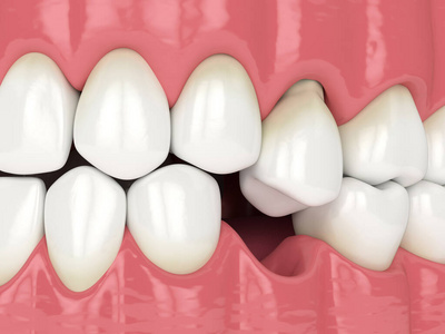 损失 揭示 闭塞 正畸 牙科 恢复 牙龈 正畸学 植入 病理学