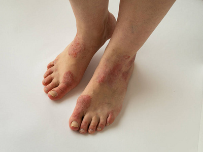 脚脂溢性皮炎初期图图片