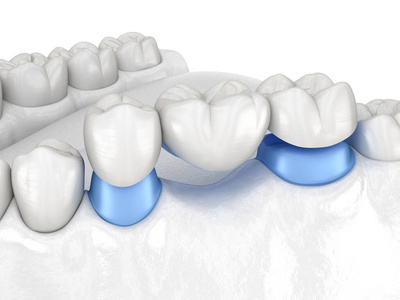 桥台 臼齿 安装 金属 治疗 外科手术 疼痛 安置 牙科