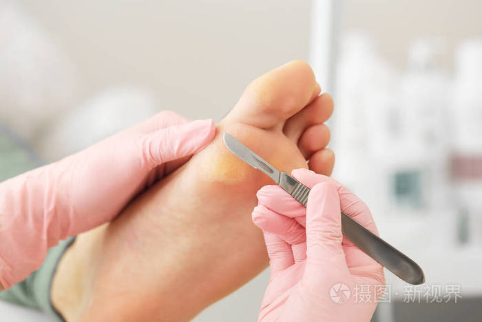 专业人士迪芬巴赫修脚手术刀.病人参观足科医生.