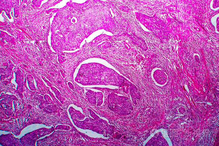子宫鳞状细胞癌光镜