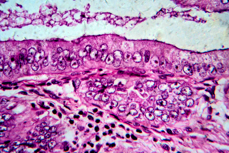 子宫内膜癌图片