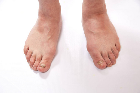 身体 不适 医学 脚趾 真菌 损伤 感染 损害 指甲 疼痛