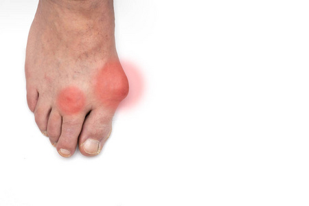 内翻外翻和拇趾外翻,白底布尼昂.空位.照片