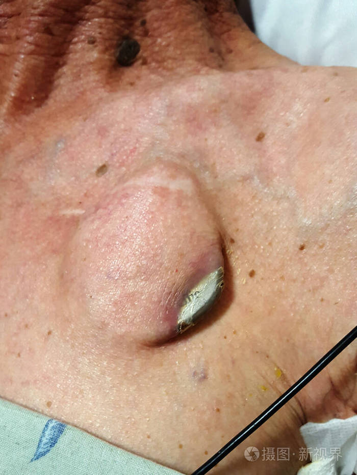 恶病质患者心脏起搏器从口袋中挤出