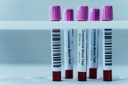 用于实验室血液分析的连续的血液试管。冠状病毒实验室检测病人血液样本。阳性反应为冠状病毒或covid19感染。