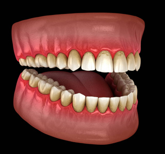 微积分 病人 健康 牙齿 牙医 细菌 牙科 缩放比例 炎症