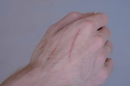 男人手上有新的猫抓痕-特写照片