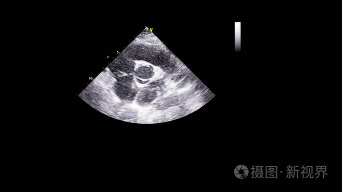 狭窄 声像图 超声检查 病人 形象 回声 高血压 中庭 多普勒