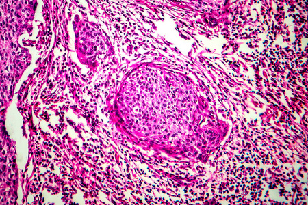 肿瘤学 肿瘤 放大倍数 妇科学 显微镜 癌症 子宫 组织病理学照片