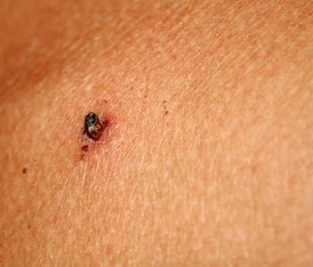 皮肤上的乳头状胎记.治疗乳突酸.照片