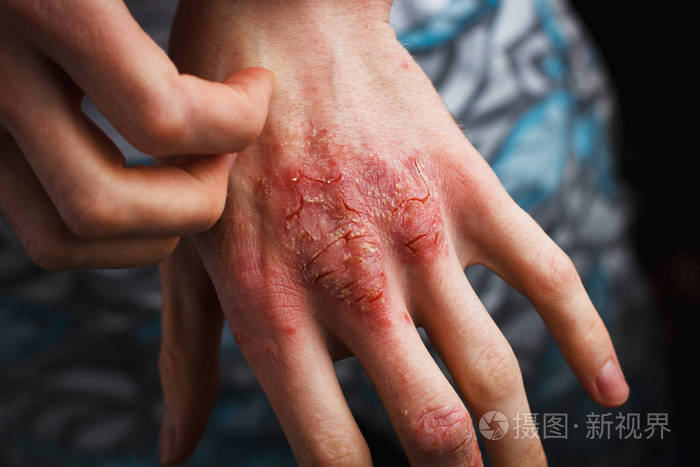 男性自残 手部皮肤干燥片状伴有寻常性银屑病 湿疹等皮肤病 如真菌 斑块 皮疹和斑片 自身免疫性遗传病 照片 正版商用图片2gujpg 摄图新视界