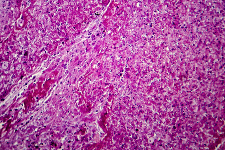 细胞的坏死图片