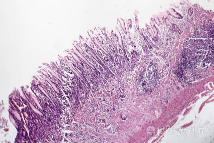 慢性萎缩性胃炎光镜