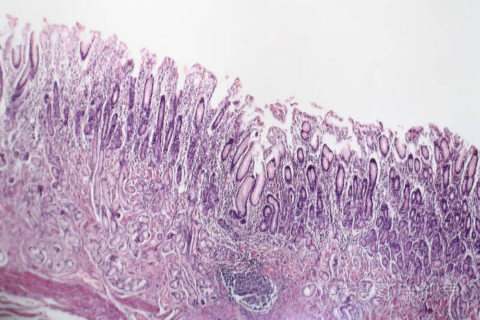 慢性萎缩性胃炎光镜
