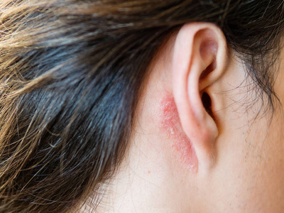 皮肤剥落的人.过敏或真菌病.照片