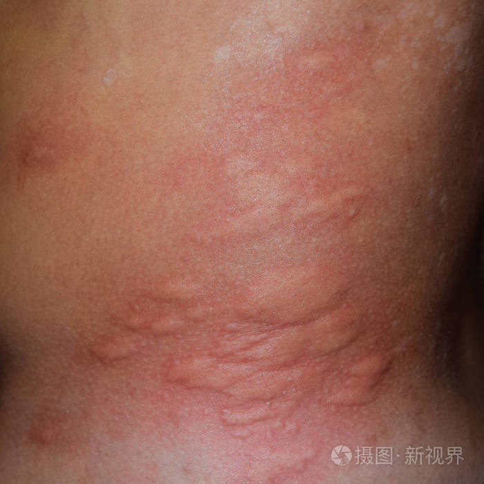 背部和两侧皮肤过敏皮肤上的过敏反应表现为肿胀和发红