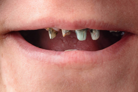 那女人张大了嘴,把她那歪歪烂的牙齿近距离露了出来照片