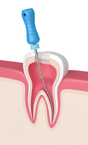 牙髓锉在牙龈中的三维绘制图片