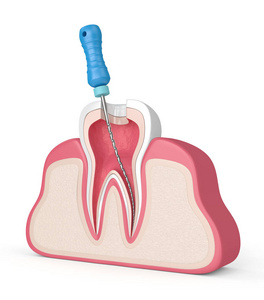 牙髓锉在牙龈中的三维绘制图片