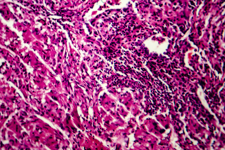 肺结节粟粒性肺结核,光镜照片