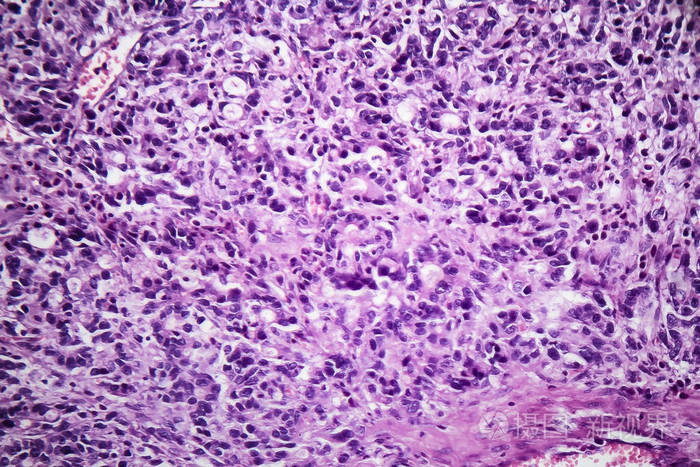 胃腺癌光镜