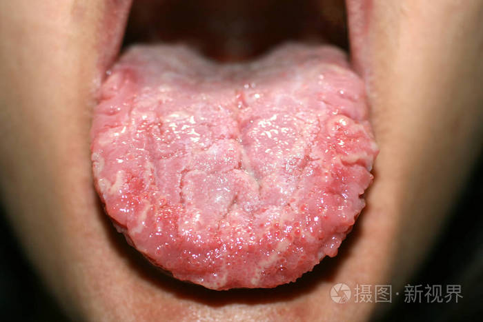 地理语言念珠菌病白色涂层念珠菌的语言