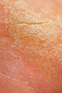 有裂纹的旧骨痂特写图片.照片