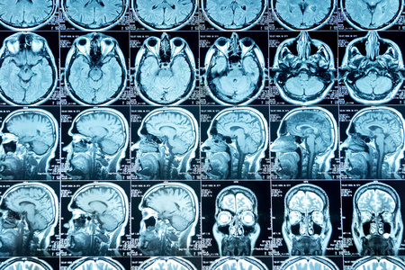 脑部核磁共振扫描照片