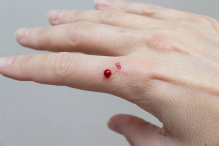 女性手上的流血伤口,皮肤损伤,受伤照片