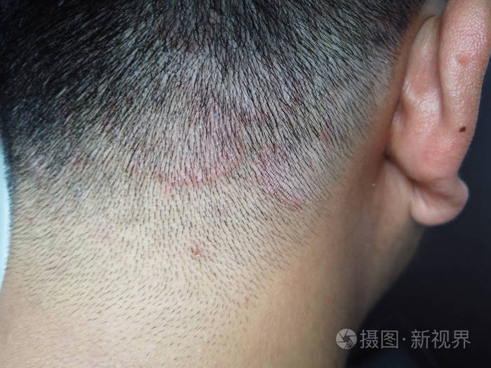 亚洲人头部癣癣闭合皮炎