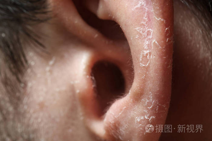 晒伤后耳朵表皮脱落