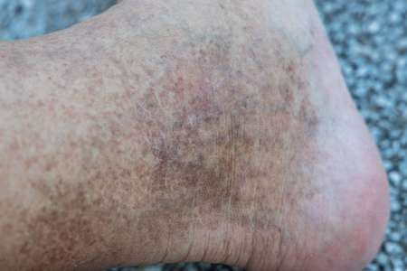 皮肤色素沉着图片