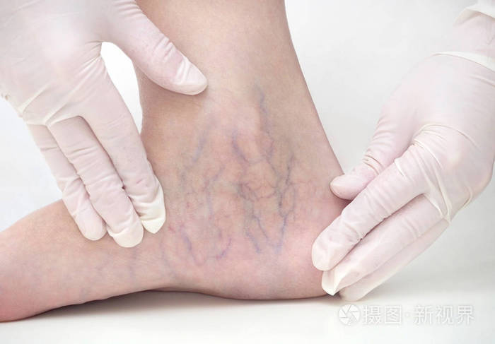 女性腿部蜘蛛静脉硬化治疗